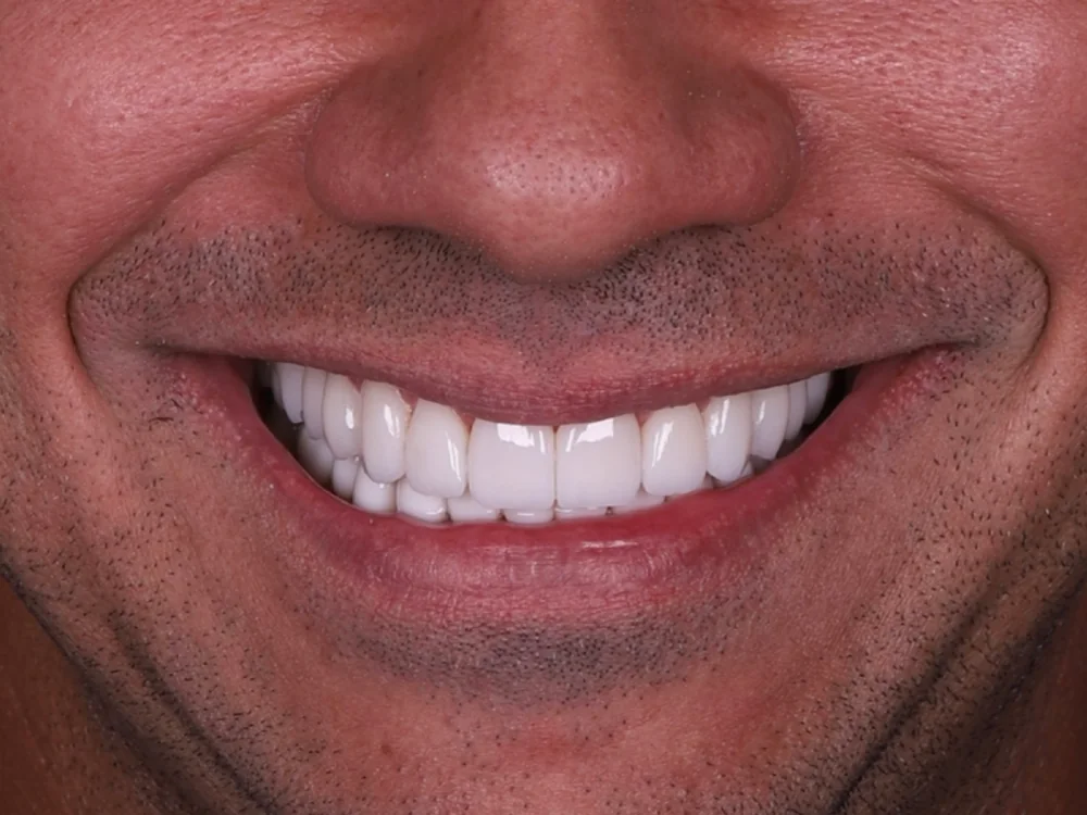 Estética do Sorriso depois do tratamento
