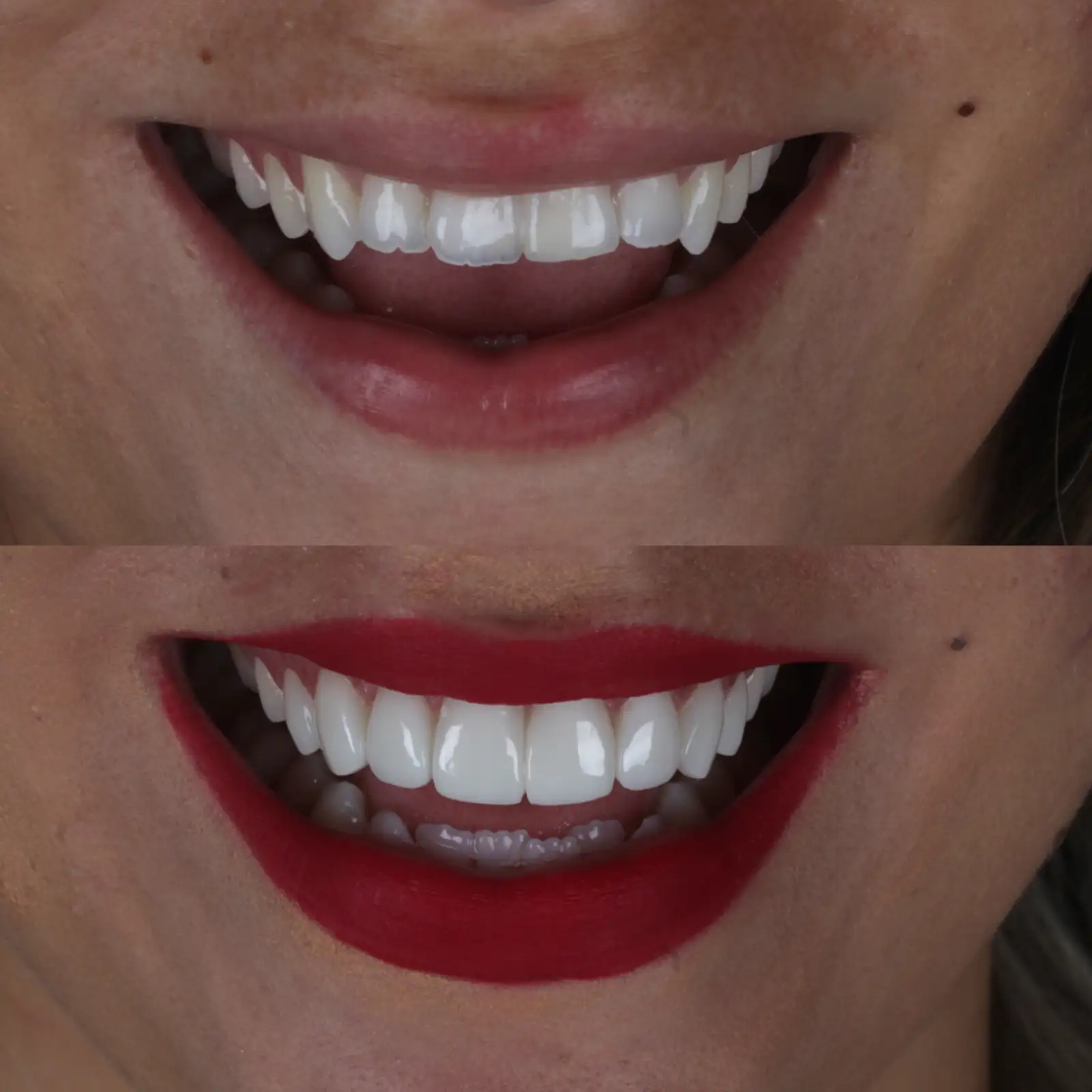 Lentes em resina — Instituto Ama